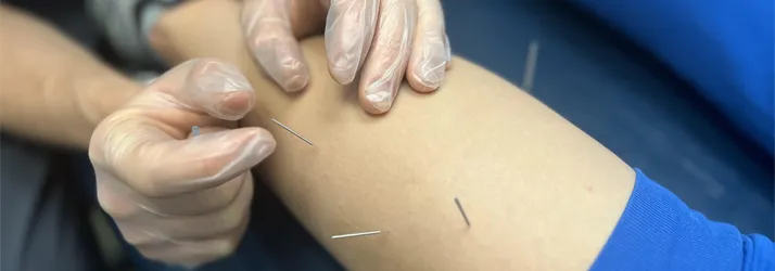 Chiropractic Rock Hill SC Dry Needling Chiropractic Rock Hill SC Dry Needling